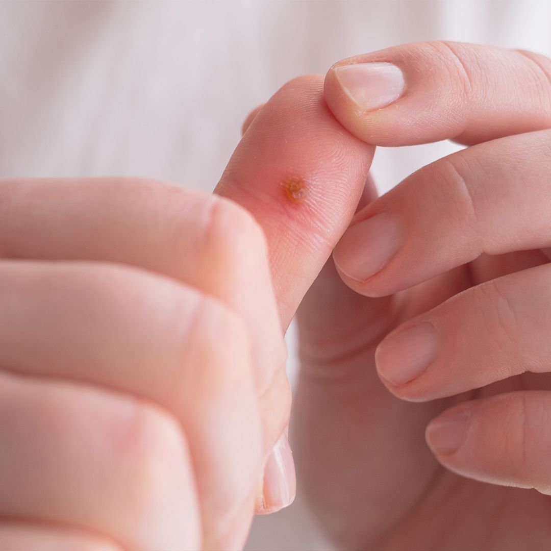Warzen entfernen: Was hilft wirklich? Hände halten einen Finger mit einer Warze