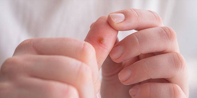 Warze Hände halten einen Finger mit einer Warze